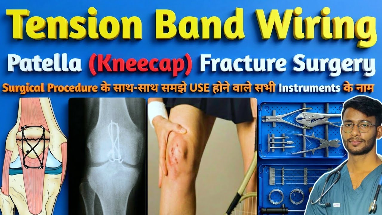 🦴Kneecap: Patella Bone Fracture Surgery | Tension Band Wiring Technique | TBW Surgery Instruments