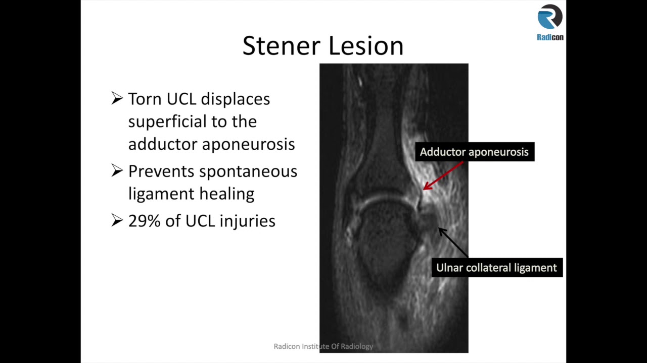 Wrist MRI Part 7: Steners lesion, Accessory muscles.