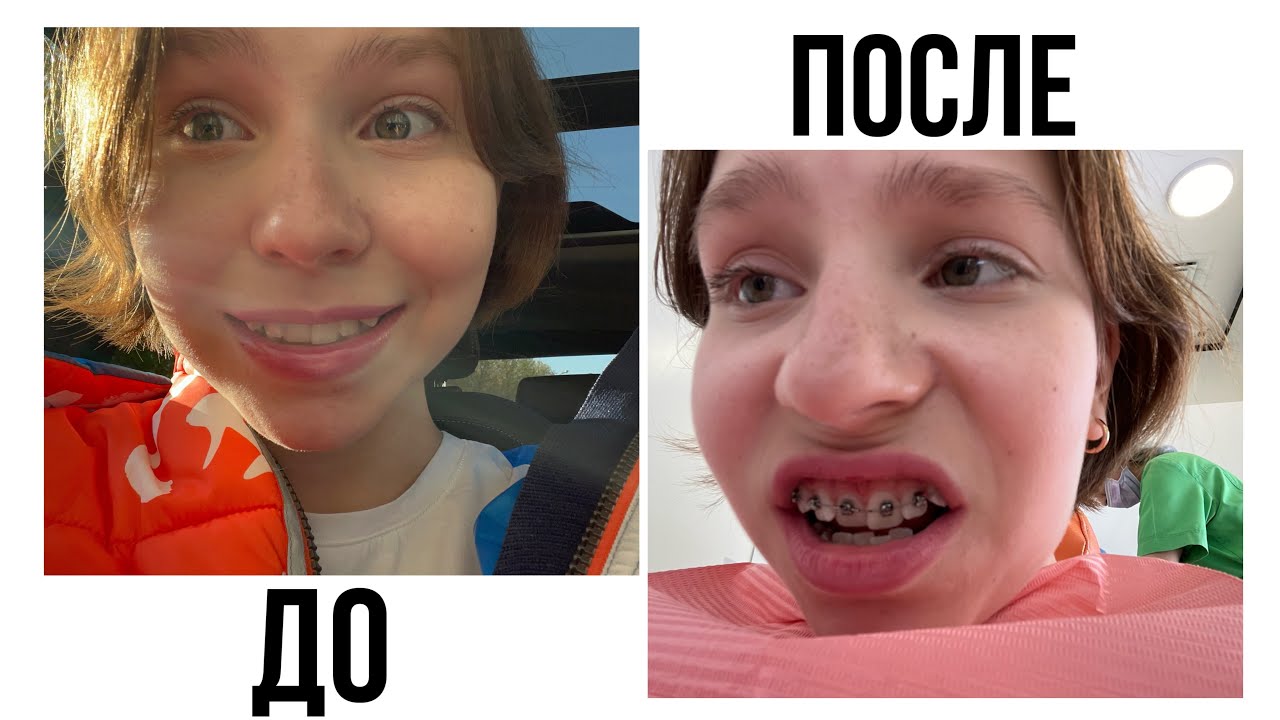 МНЕ ПОСТАВИЛИ БРЕКЕТЫ!!! ***мои ощущения + влог***