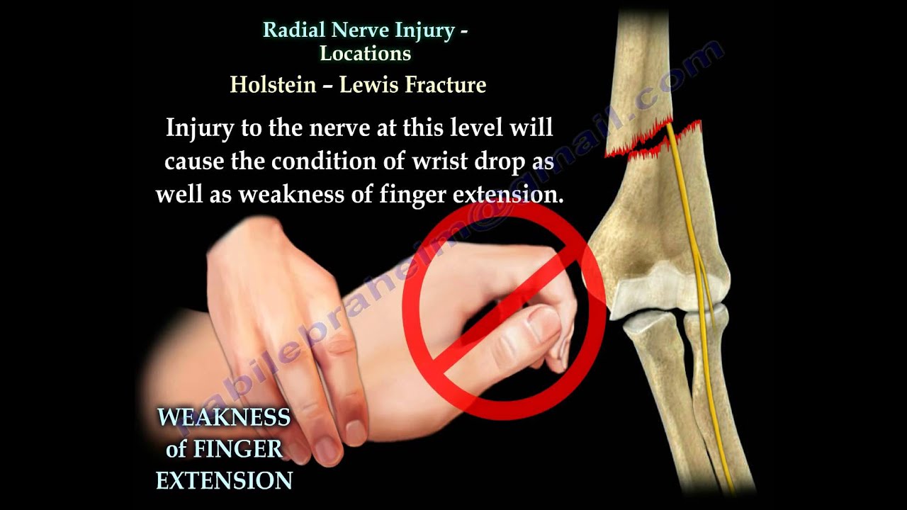 Radial Nerve Injury, Locations - Everything You Need To Know - Dr. Nabil Ebraheim