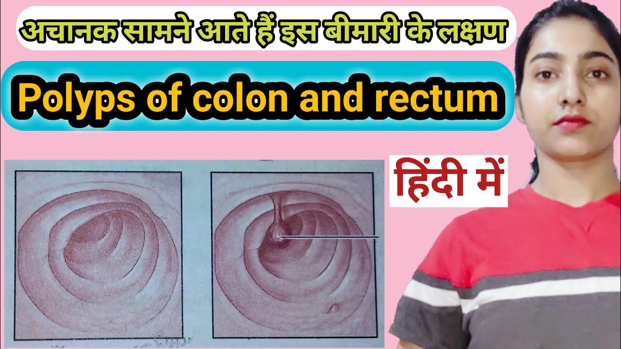 polyps of colon and rectum in hindi |Causes and risk factors|Symptoms|Treatment|Msn|