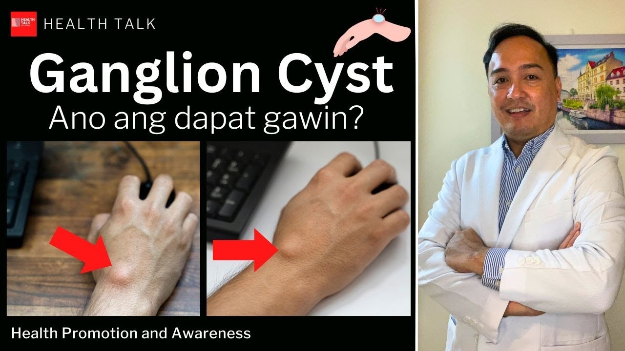 Ganglion Cyst: Causes, Risk factors, Diagnosis, Treatment and Prevention