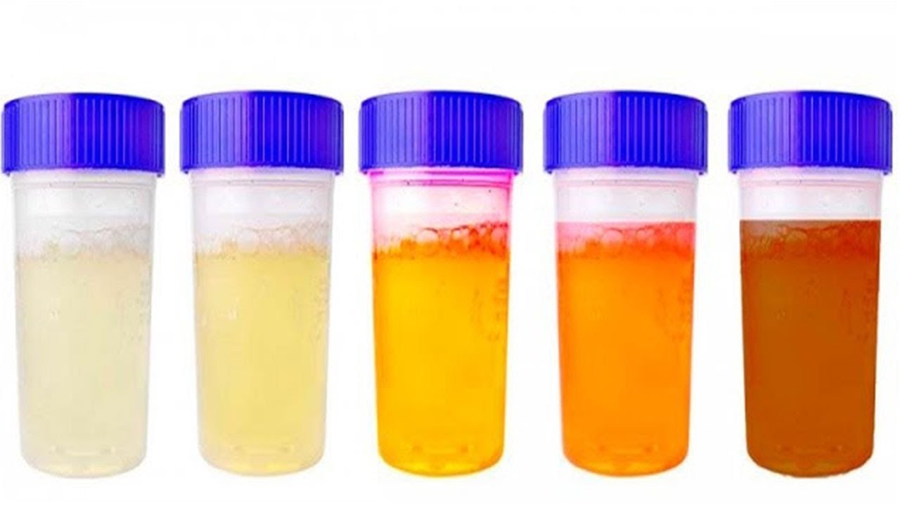 Was die Farbe des Urins über die Gesundheit verrät!