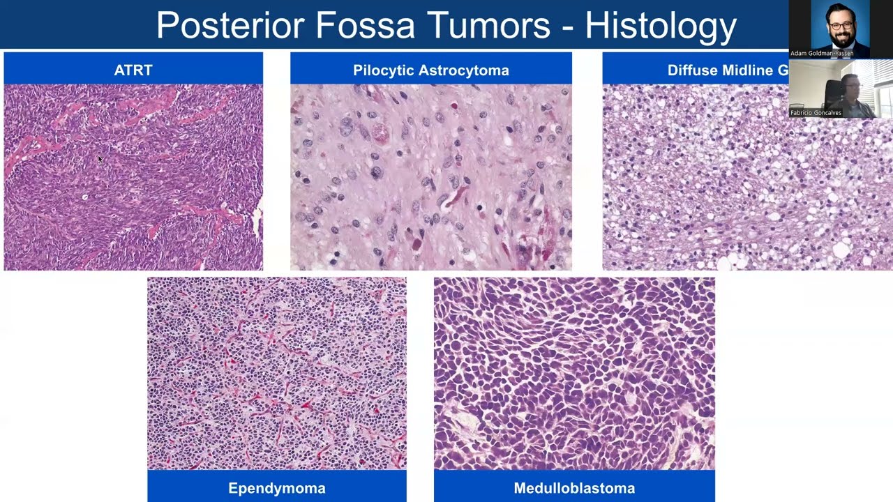 Posterior Fossa Tumors -- Dr. Fabrício Gonçalves -- 2.22.2024