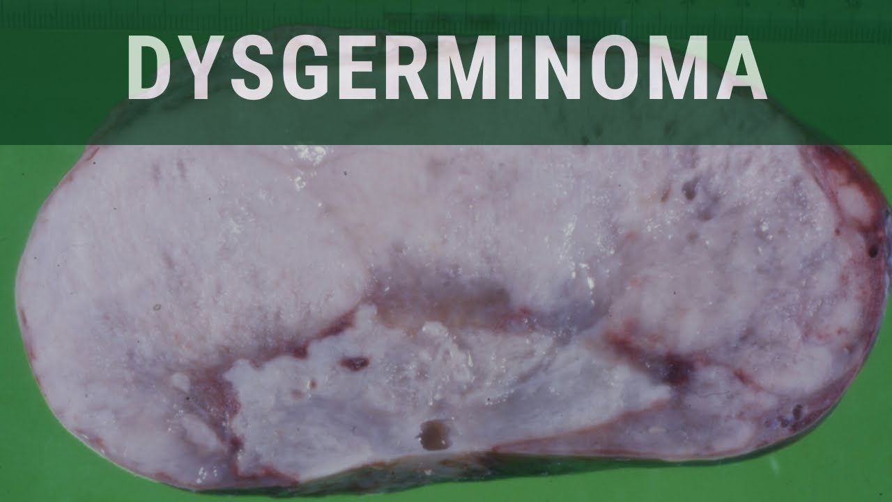 Ovarian Dysgerminoma - Pathology mini tutorial