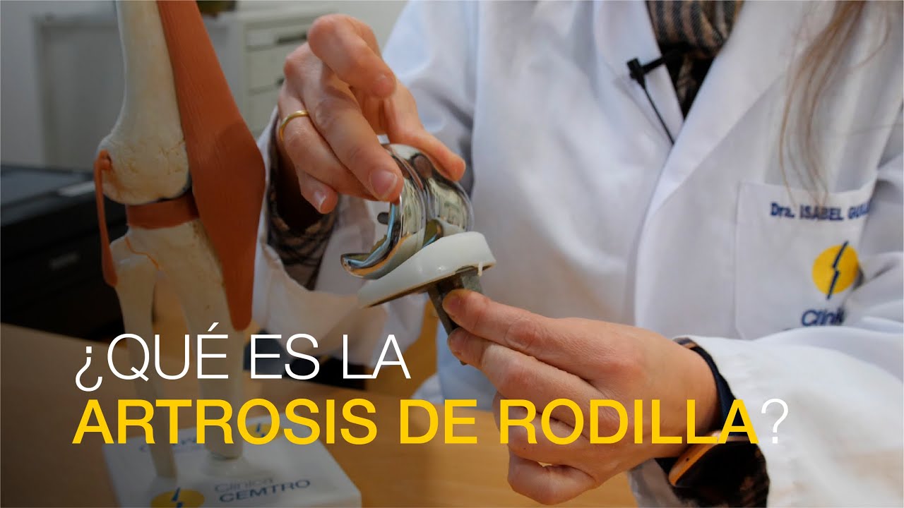 ¿Qué es la artrosis de rodilla?