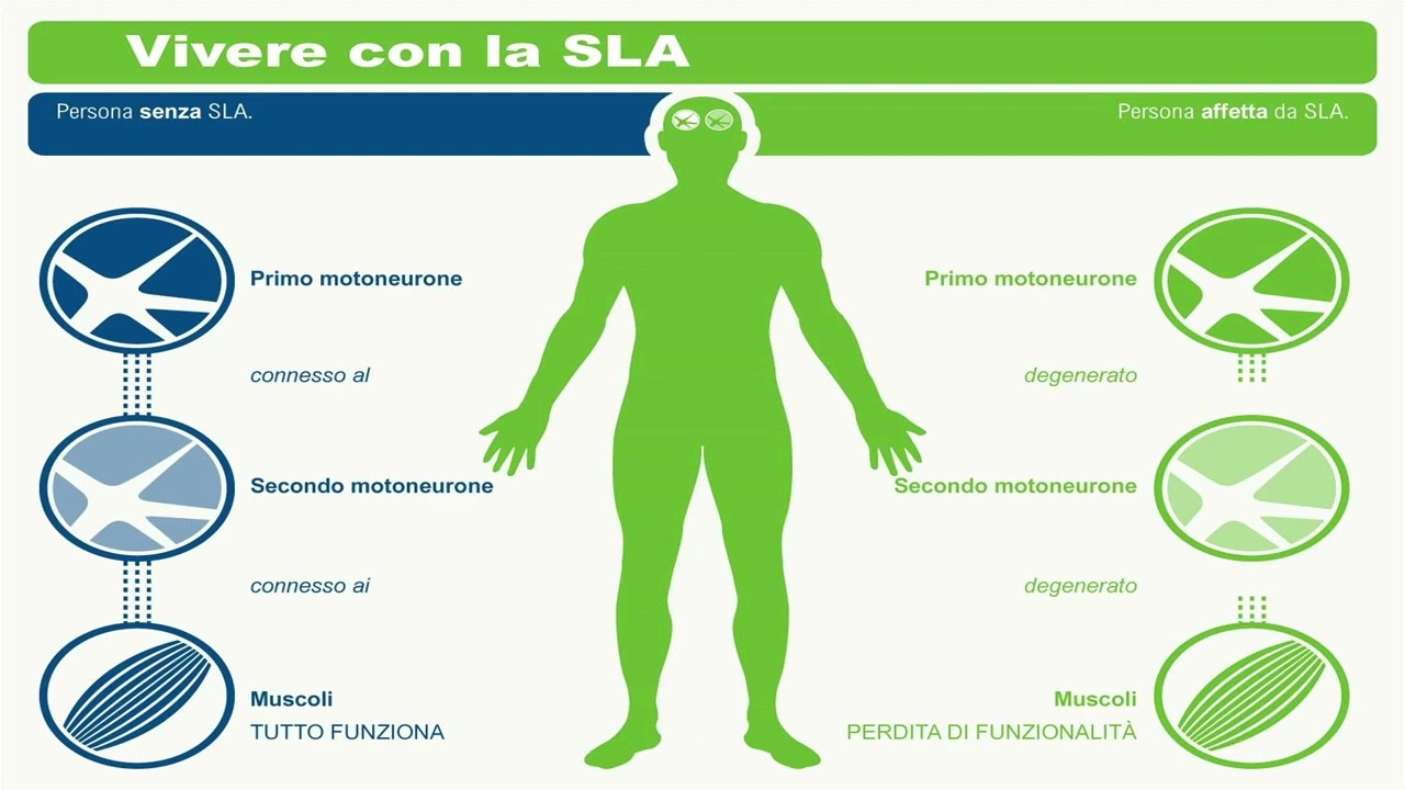 9.5 La SLA - Sclerosi Laterale Amiotrofica