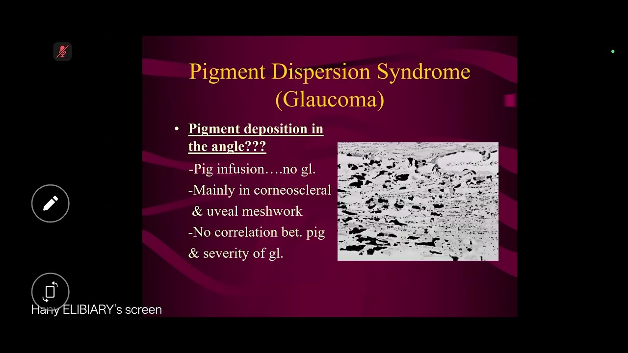 Glaucoma Pathology 2026