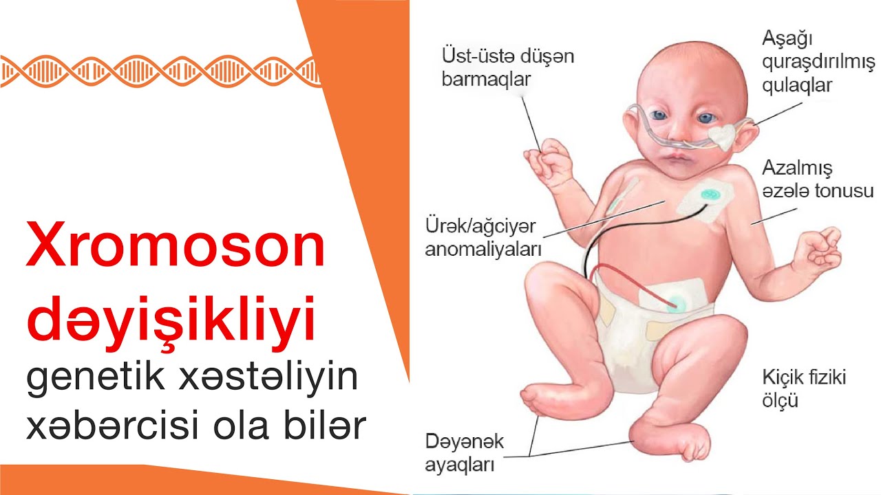 Xromosom dəyişikliyi genetik xəstəliyin xəbərçisi ola bilər