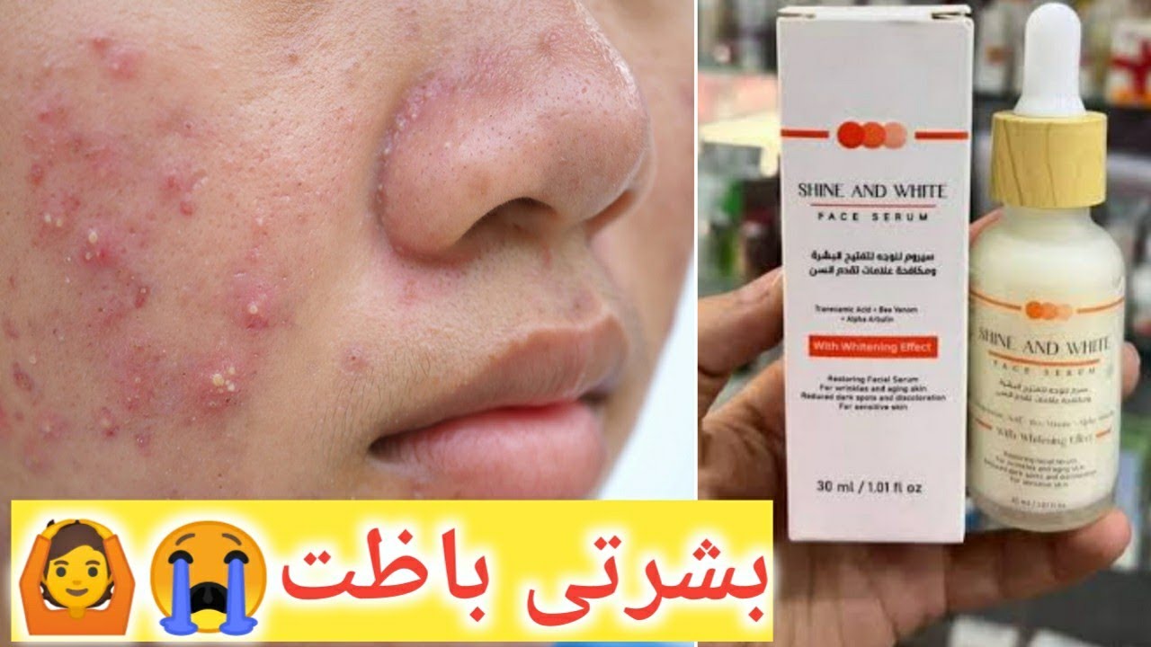 متشتريش سيروم شاين أند وايت قبل ما تشوفي الفيديو ده! (ندمت؟) هل فعلاً بيفتح البشرة ولا دعاية وبس؟