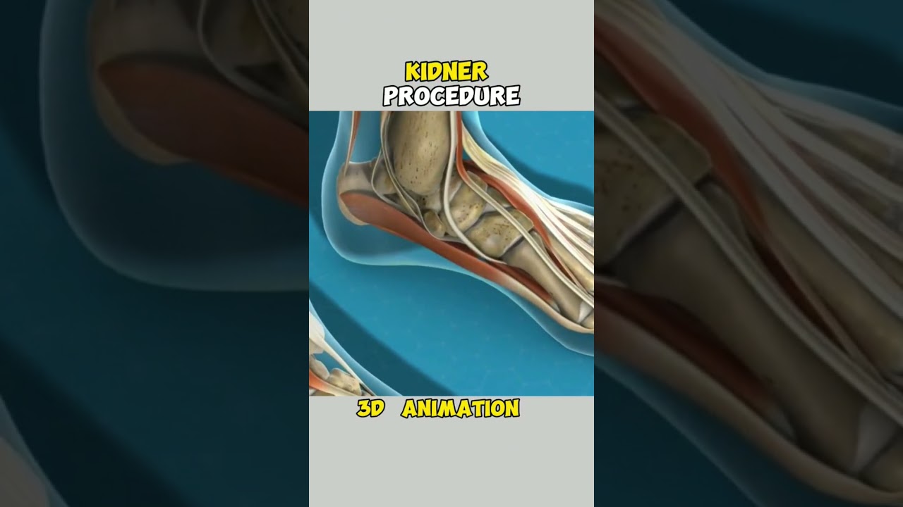 kidner procedure#surgicaleducation#surgical_ot#surgicalmasks