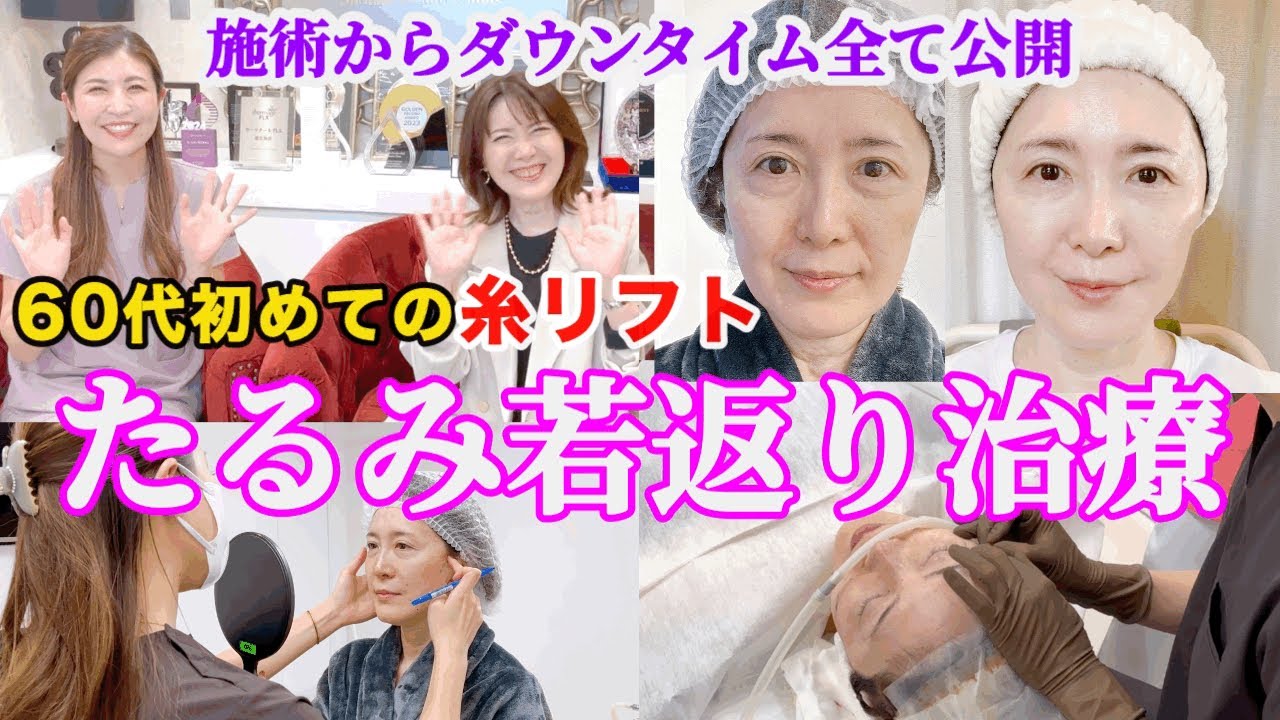 【糸リフト】61歳全顔若返りでマイナス10歳！目の下たるみ、ほうれい線 @アジュンマTV