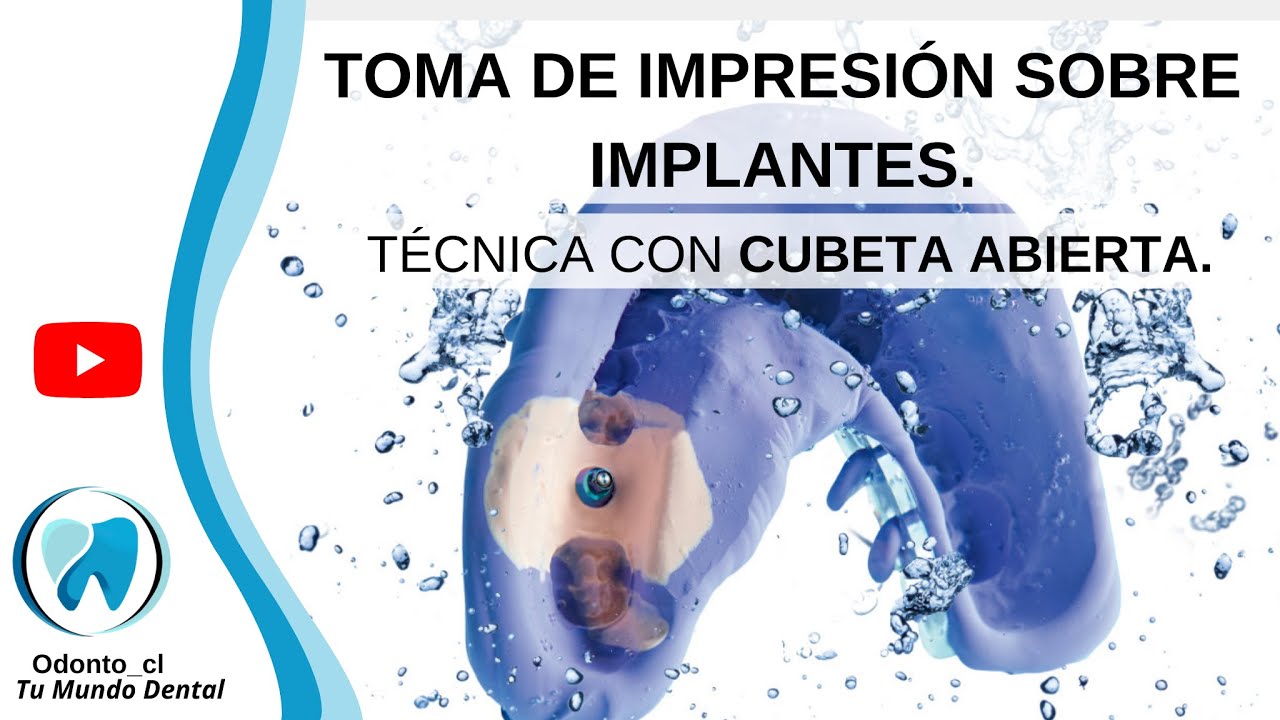 📋GU&Iacute;A PASO A PASO. Impresi&oacute;n de implantes con cubeta abierta