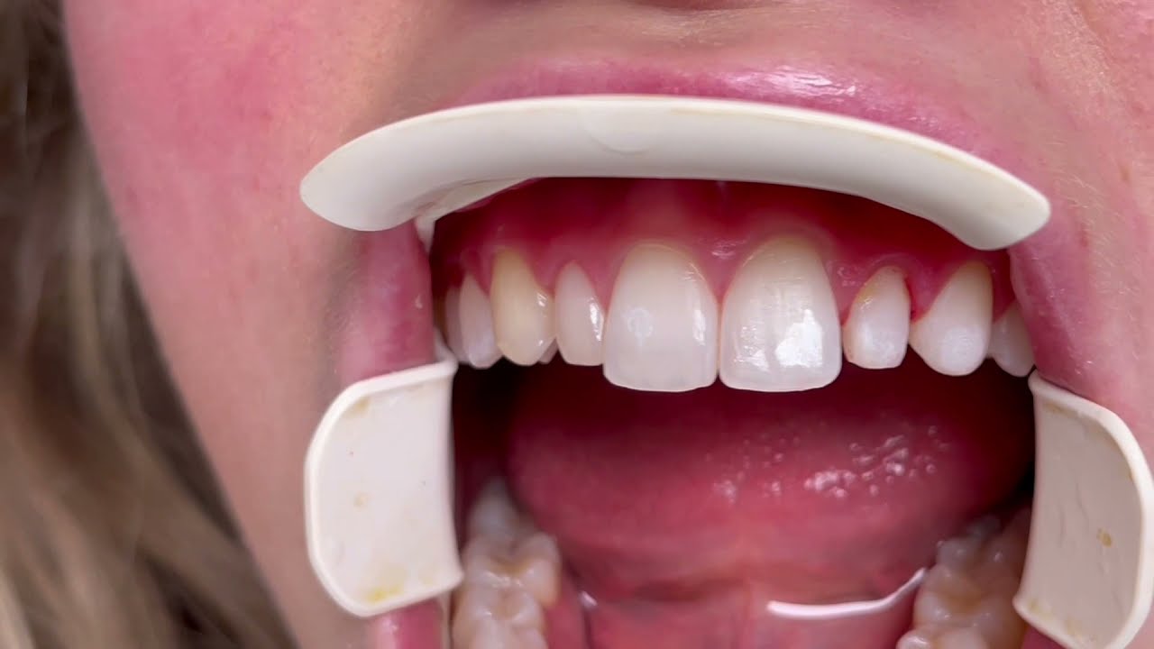 Houston Cosmetic Dentist... Great results with just a few veneers! Don't need to veneer all !