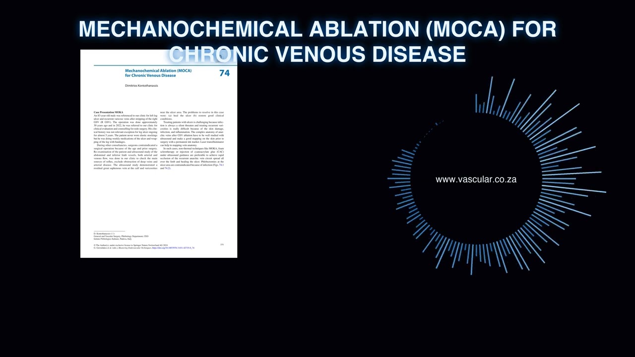 MET - 74 - Mechanochemical Ablation MOCA for Chronic Venous Disease - Deep Dive Podcast