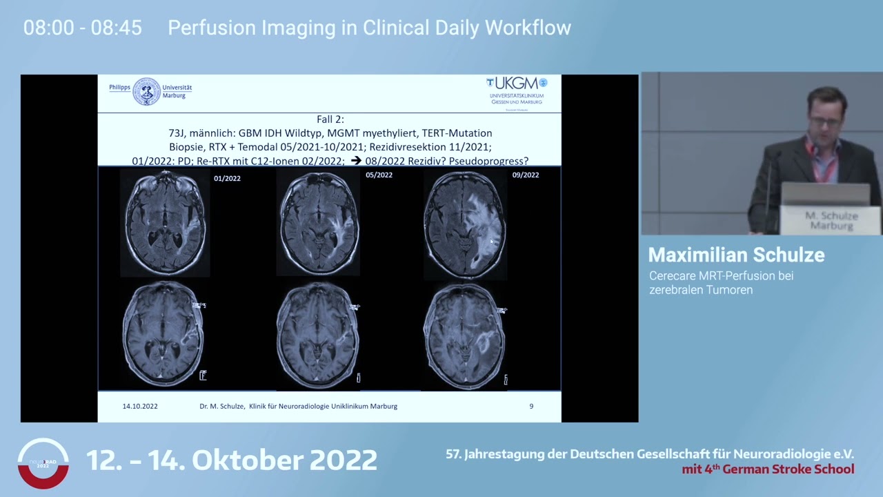 Maximilian Schulz on Cercare Perfusion Software for CNS Tumors | Neurorads 2022