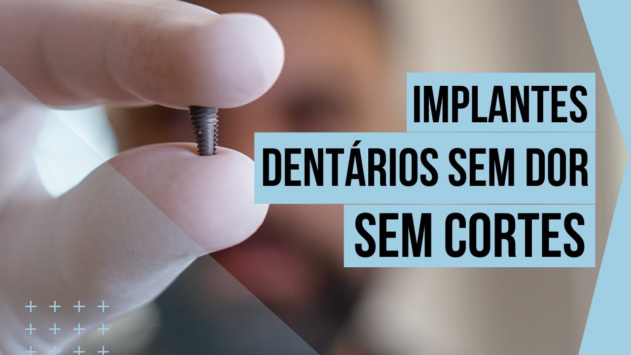 Implantes Dent&aacute;rios Sem Dor e Sem Cortes! Saiba Mais! (Cirurgia Guiada por Computador)