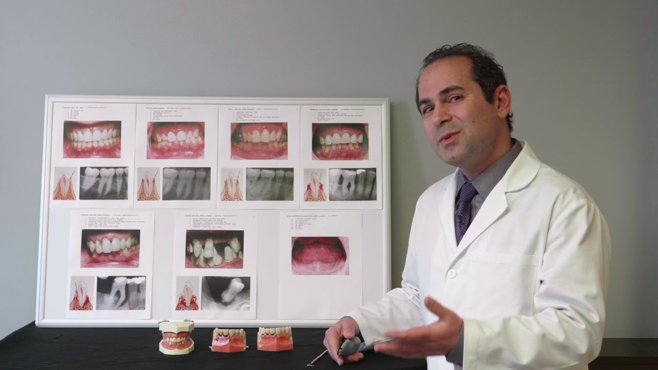 Gum Disease Stages