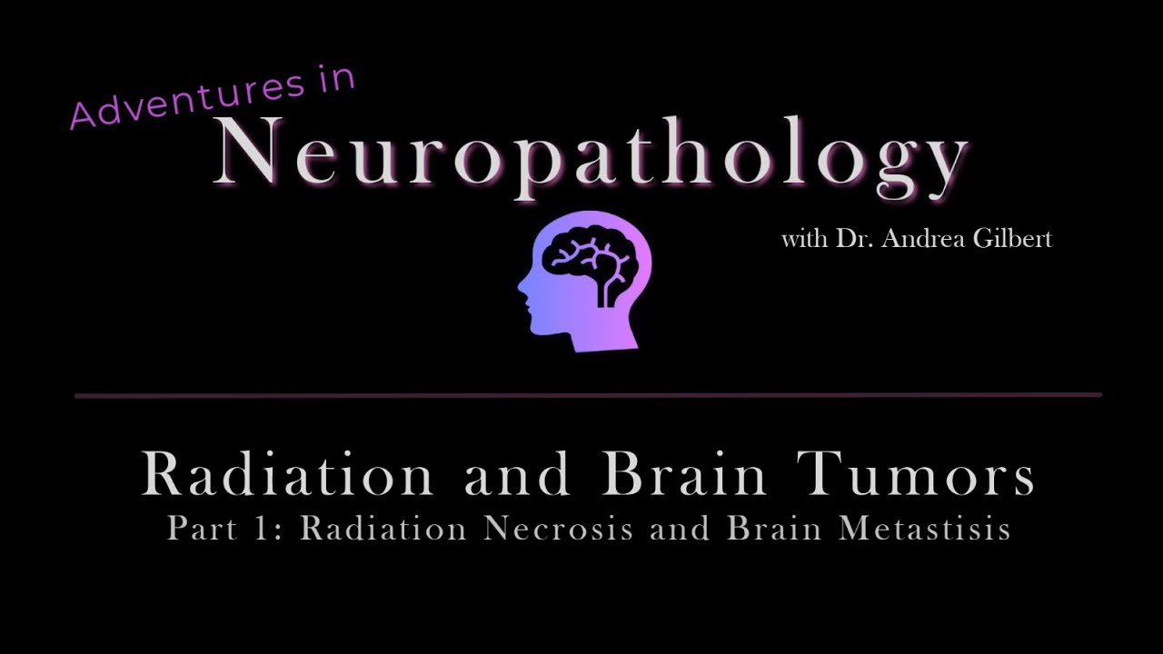 Radiation and Brain Tumors, Part 1:  Radiation Necrosis and Brain Metastasis