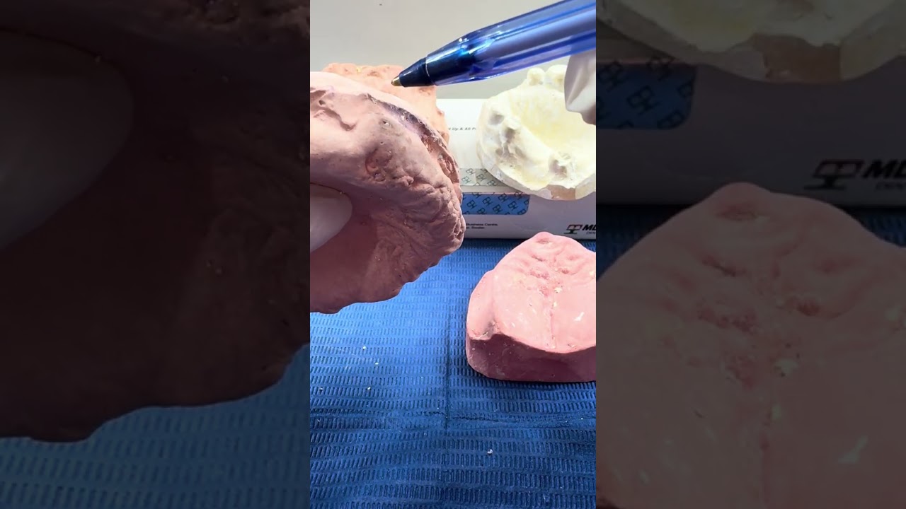 Análisis de modelos reales superiores para elegir técnica de cucharilla individual 