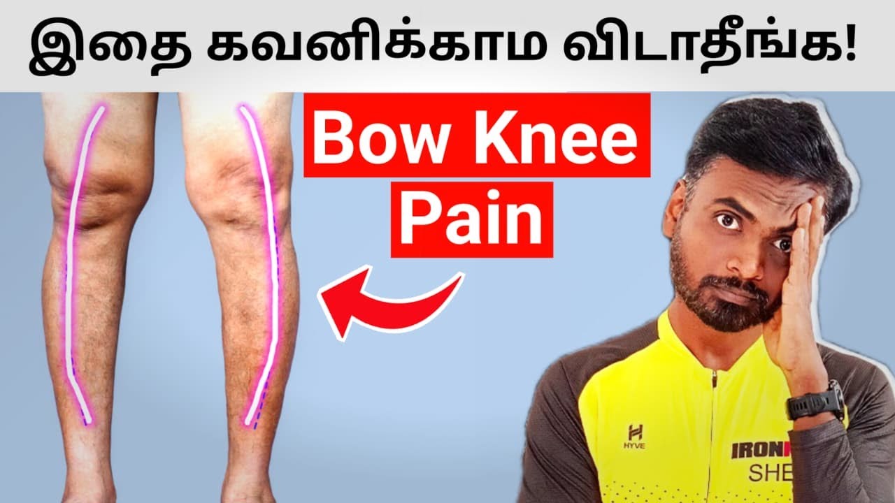 Bow Knees - Knee Pain While Walking? Try This 5 Home Workout