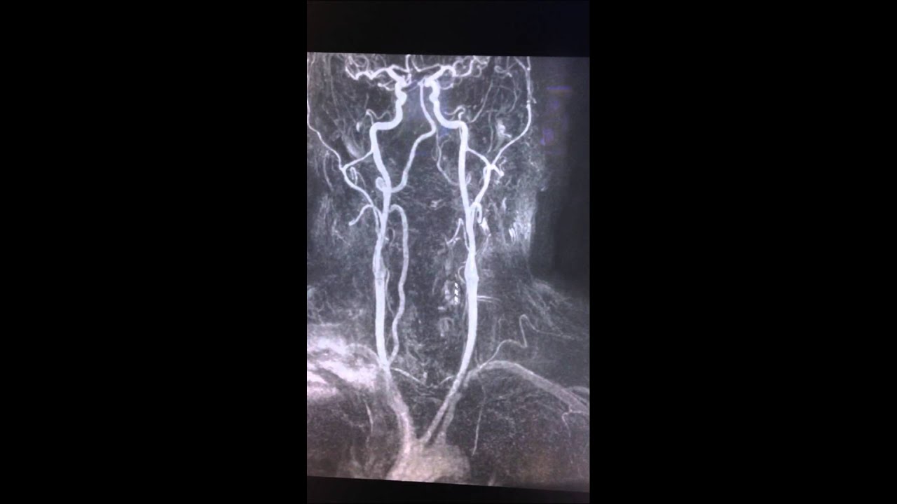 Subclavian steal