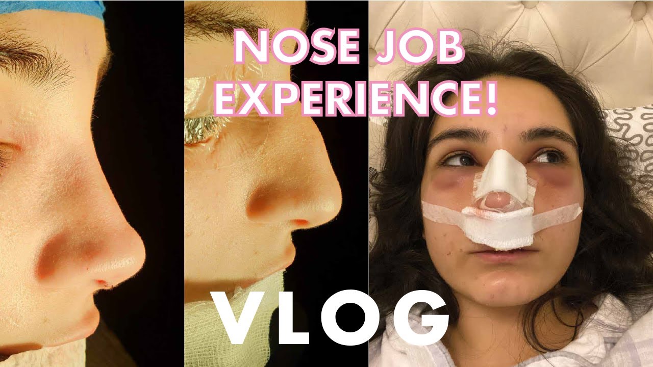 VLOG 8 | I got a nose job! فلوق عملية تجميل انفي