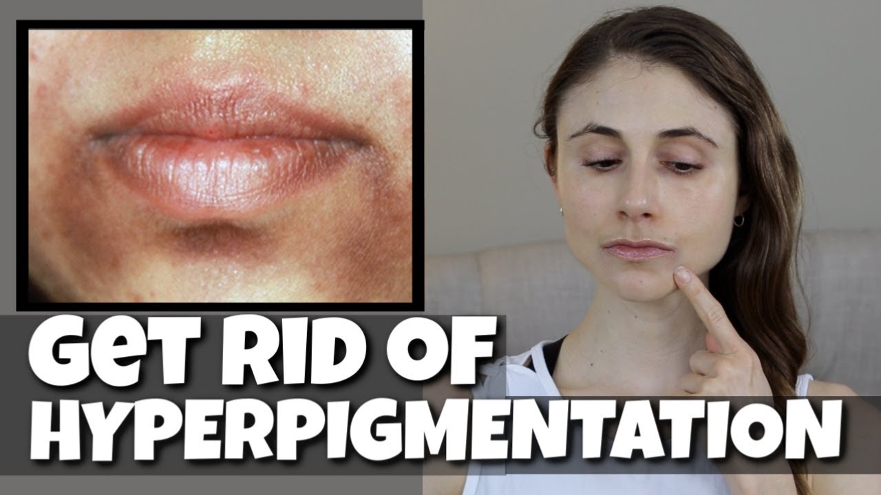 GET RID OF HYPERPIGMENTATION AROUND THE MOUTH| DR DRAY