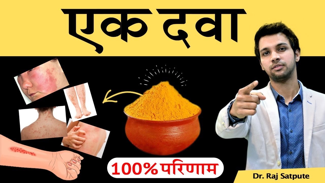 Psoriasis Treatment in Hindi by Dr Raj Satpute