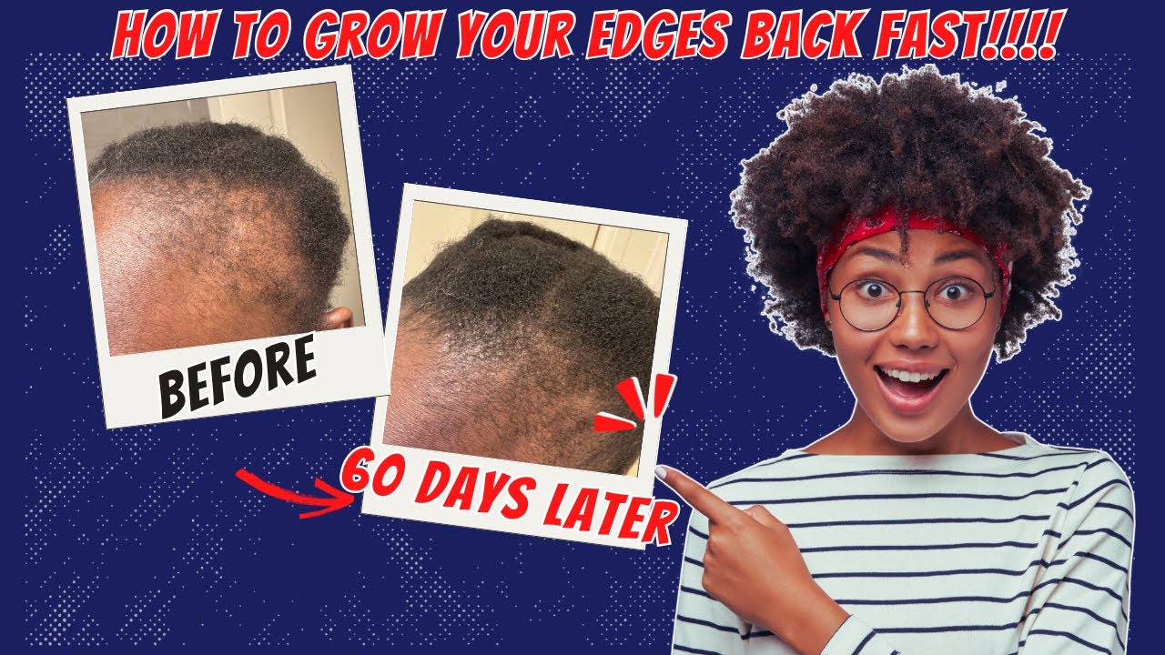 #1💆🏽&zwj;♀️ How to grow your edges back fast!!!!!