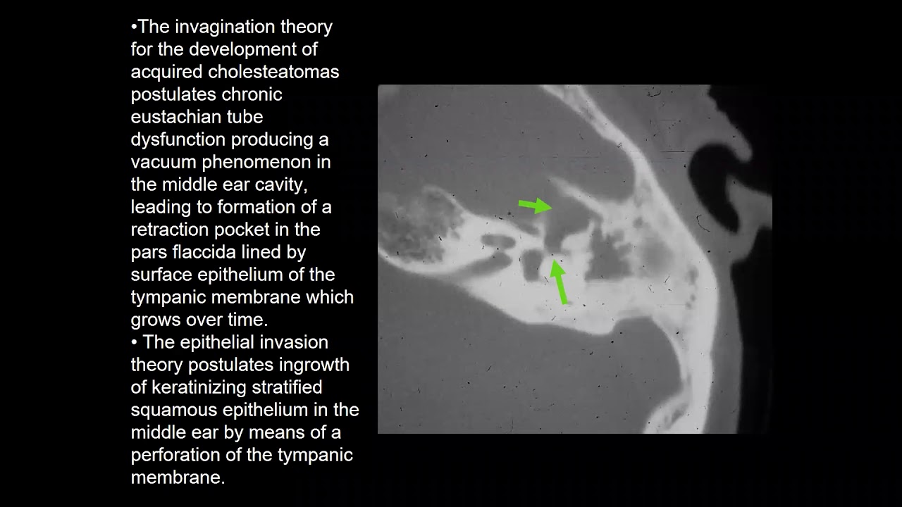 Cholesteatoma Summary - Middle Ear MRI - MRI Online