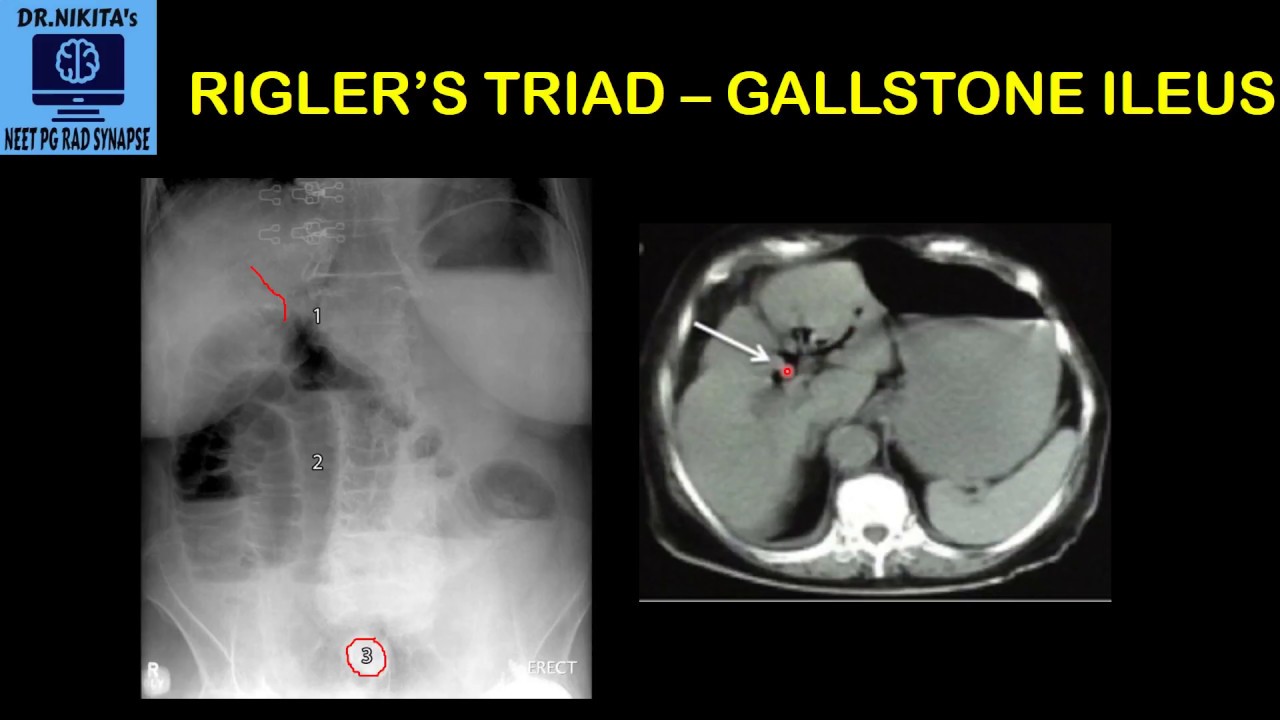 Rigler's triad  - Gallstone ileus II Understanding the concept