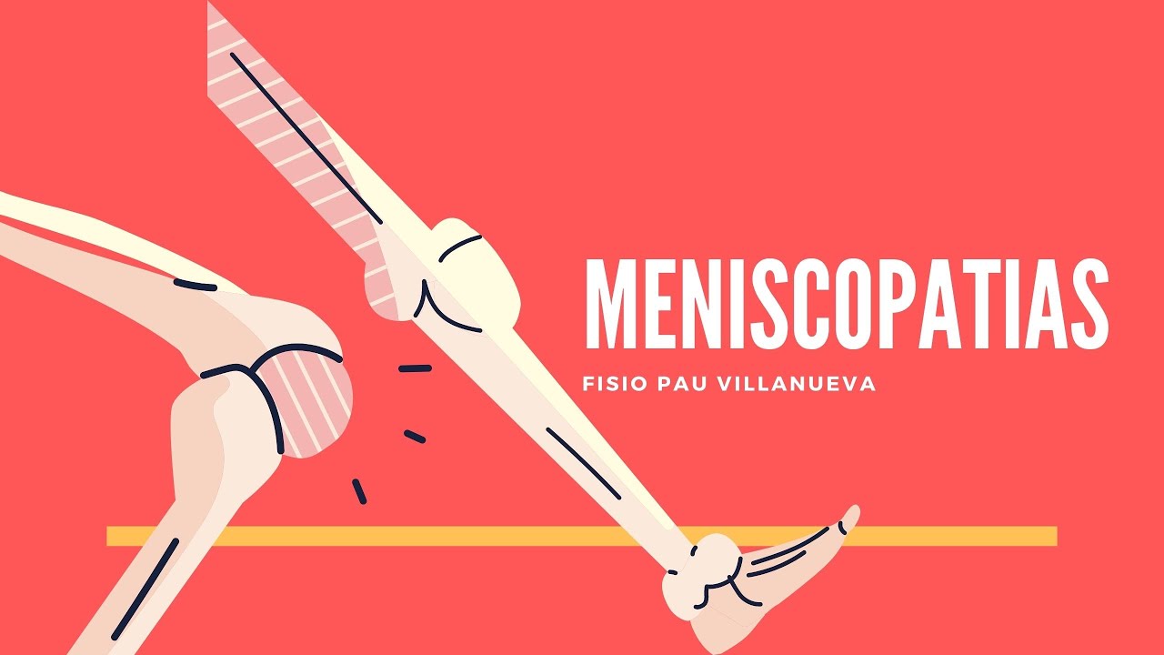 MENISCOPATIA Y BLOQUEO MENISCAL