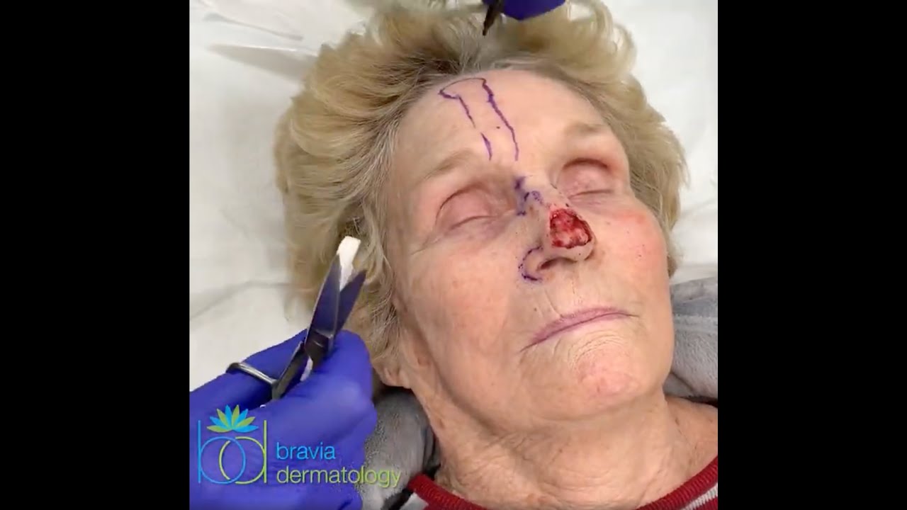 Paramedian forehead flap at Bravia Dermatology