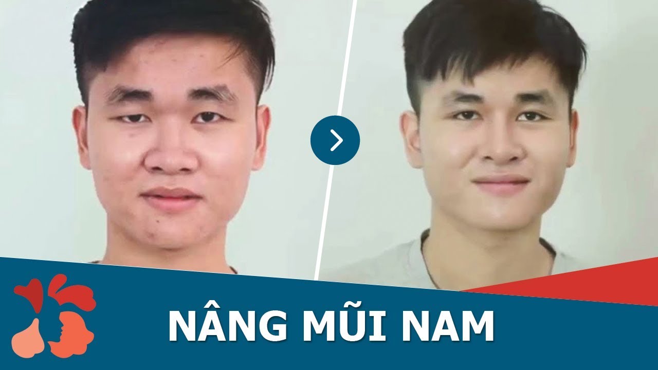 Phẫu thuật N&acirc;ng mũi cho NAM giới đẹp chuẩn H&agrave;n Quốc