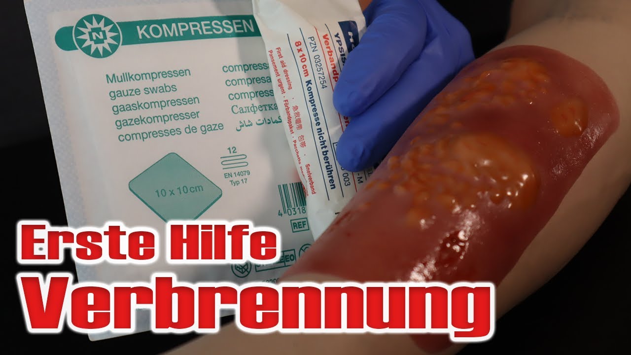 So versorgst du eine Brandwunde | Verbrennung | Erste Hilfe