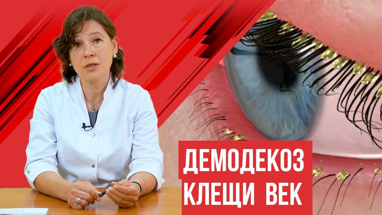 Демодекоз век, когда нужно лечение и каким оно должно быть?