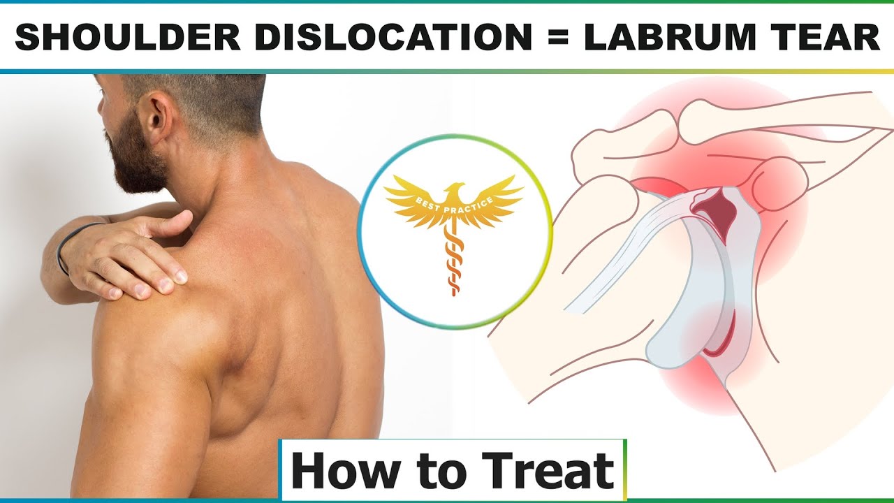 How to find orthopedic surgeon for arthroscopic shoulder labral tear repair | Shoulder dislocation