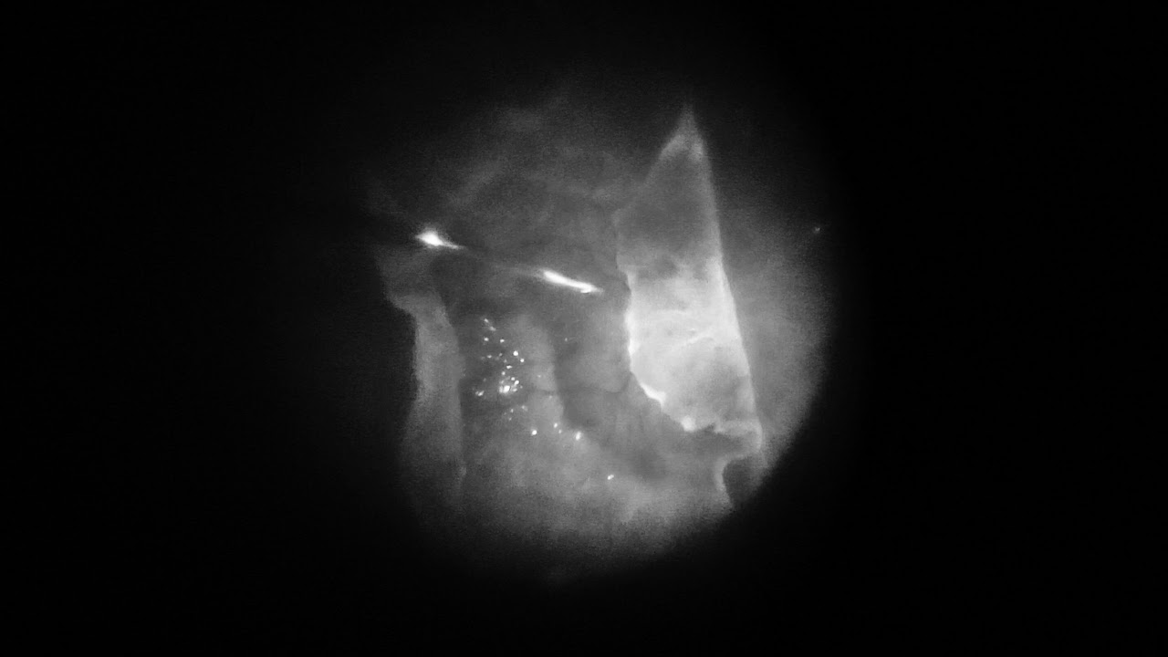 Teaser.Mishev&Huning - Severe PVR Retinal Detachment 360 Retinotomy Outcome Switch - Zoom - Video