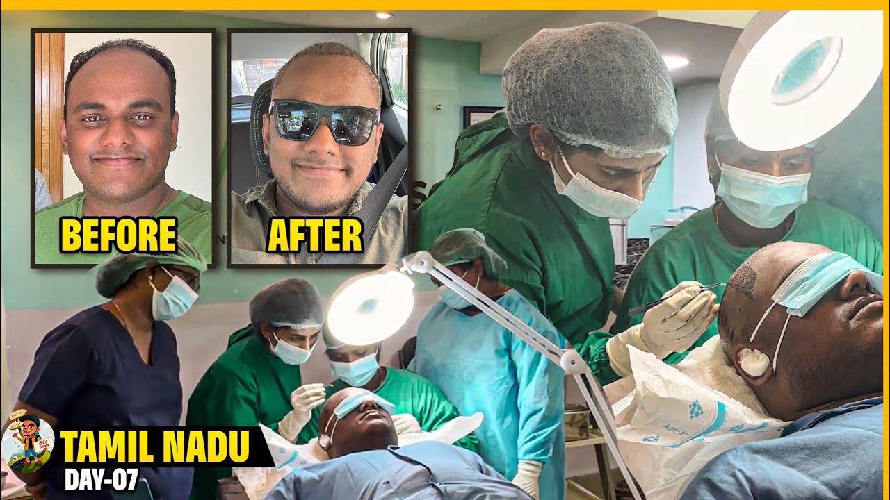 Transforming Bald to Bold: My Hair Transplant Experience | Tamil Trekker