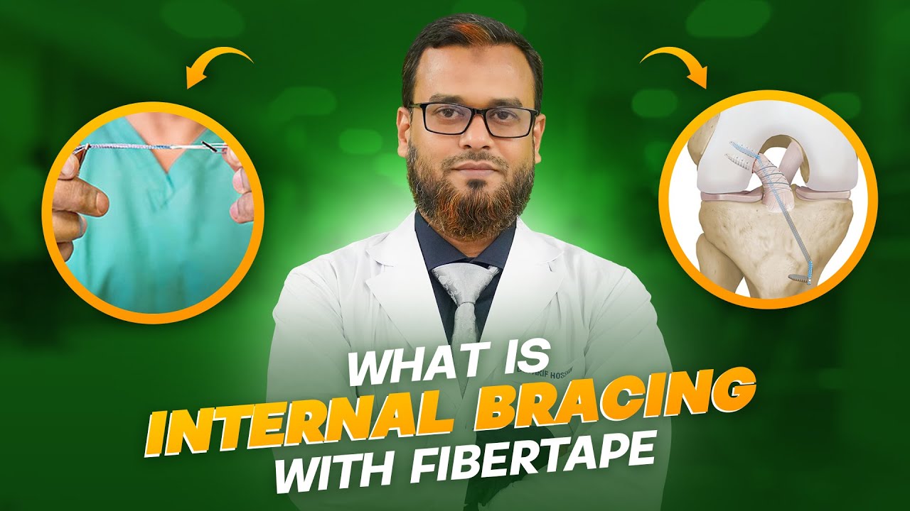 Internal bracing with fiber tape