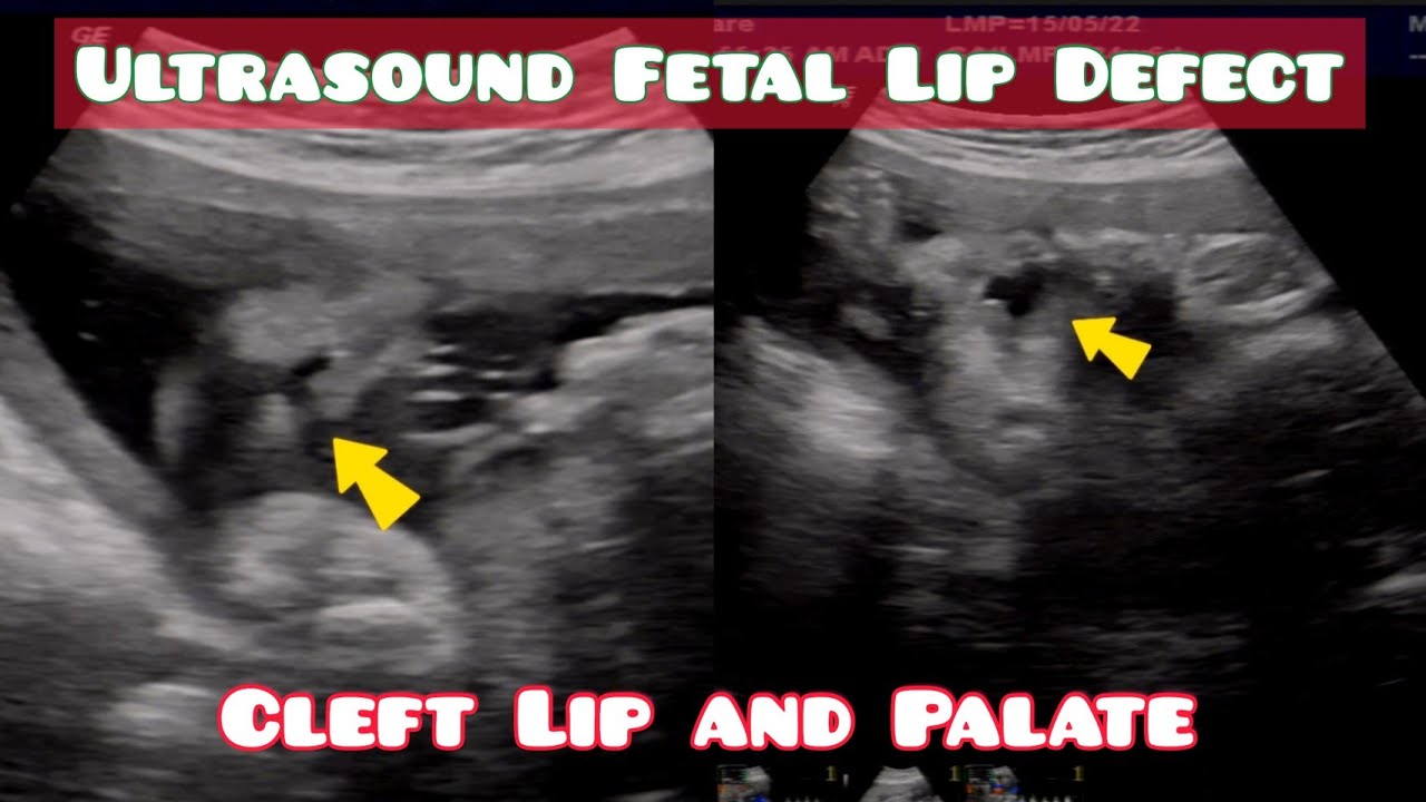 Ultrasound Showing Fetal  Lip Defect , Normal Lips vs Cleft Lip and Palate.
