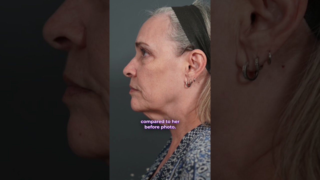 Short Scar Facelift with Dr. Paul Nassif