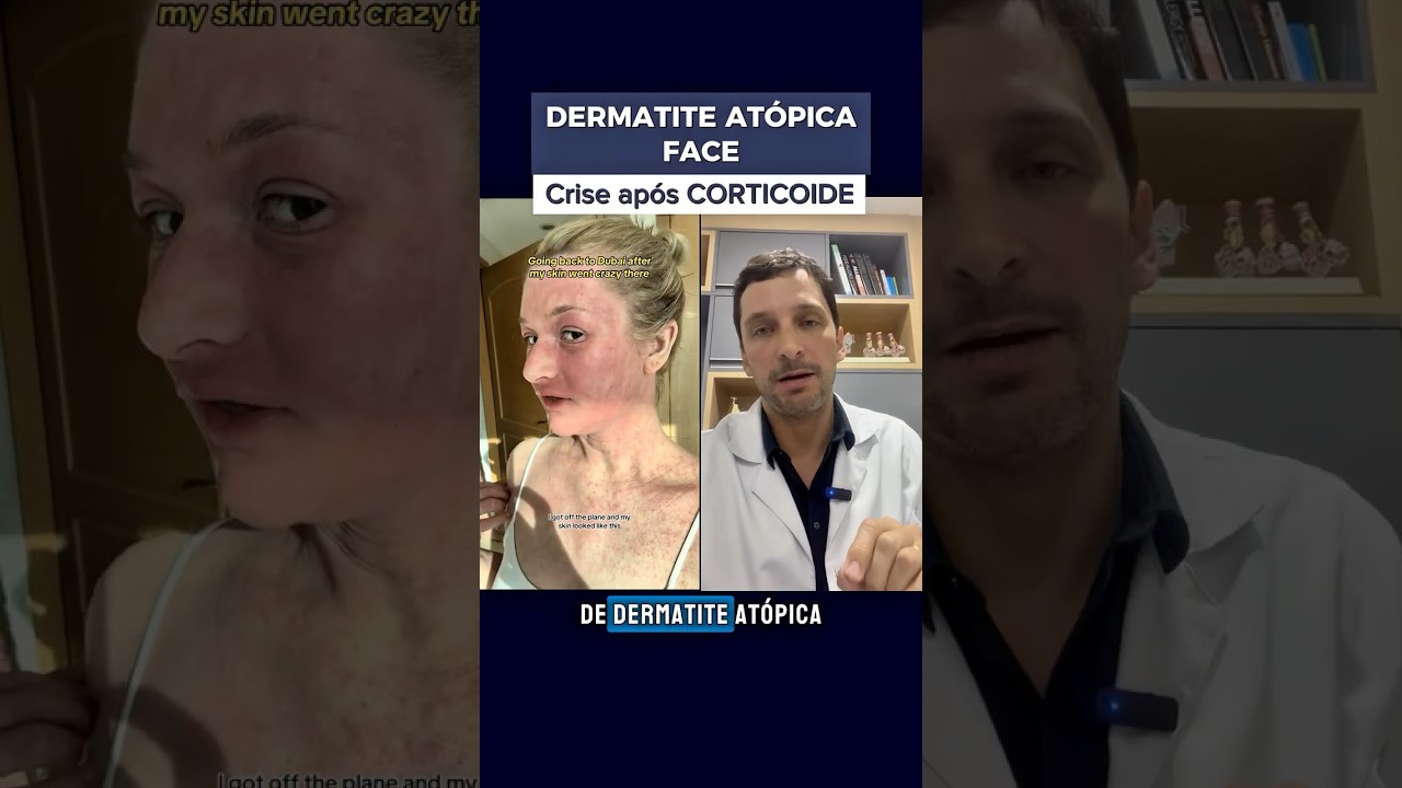 dermatite atopica e tsw (efeito rebote do corticoide) #eczema #dermatite #dermatiteatopica