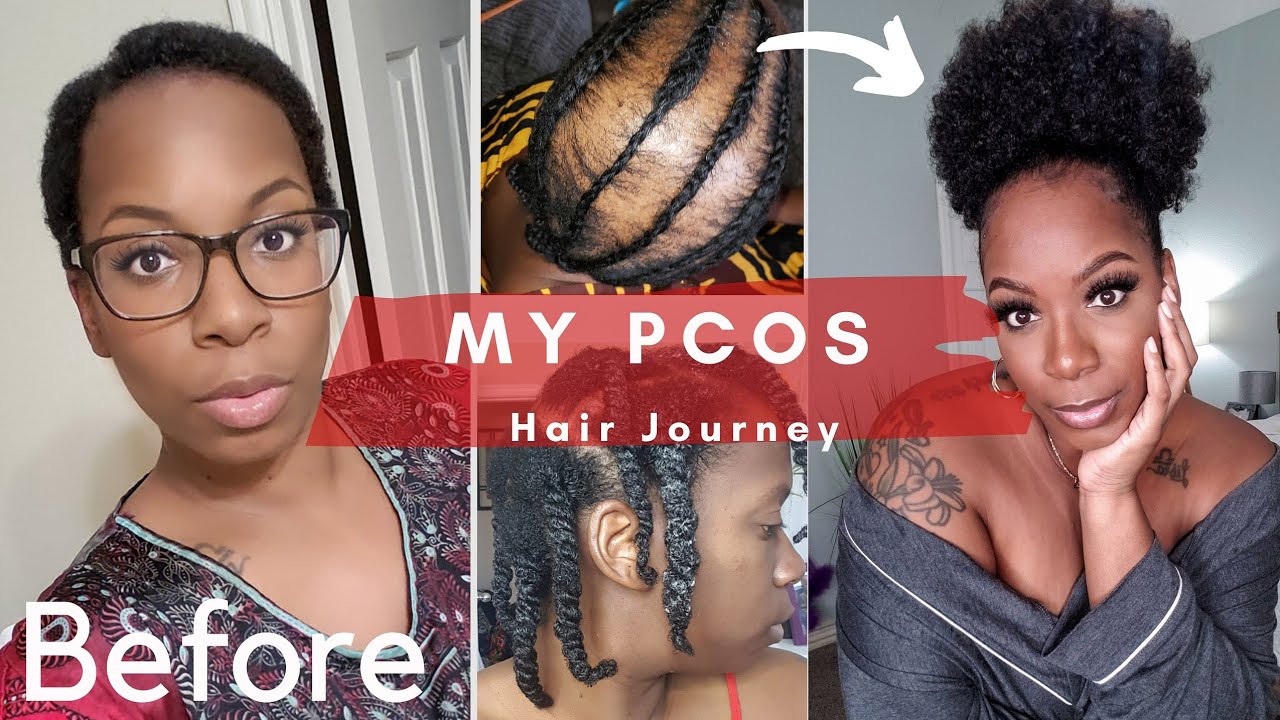 My PCOS Journey! Hair Loss Balding & Regrowth | Detailed Timeline + Products Used + Real Results!
