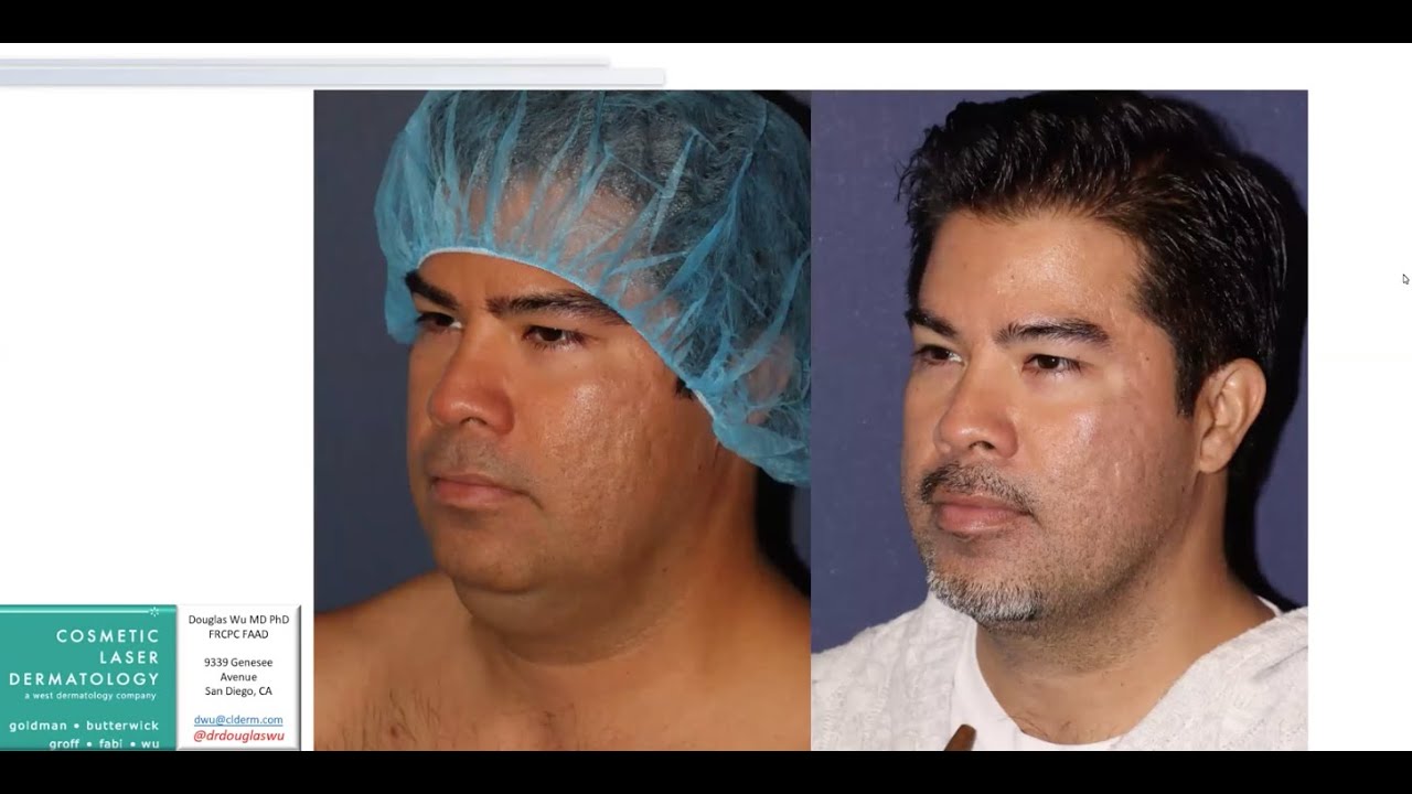 Best Body Contouring Treatments For Eliminating Double Chins and Excess Submental Fat