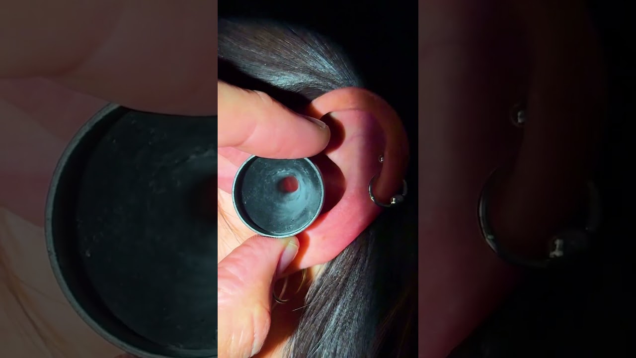 Removing a Faulty Invisible Hearing Aid  #phonak #lyric #hearingaids