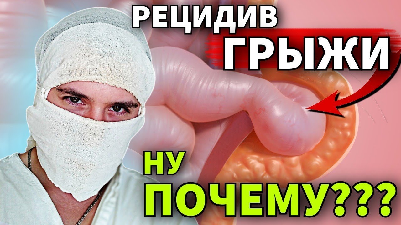 Как избежать рецидив грыжи после операции