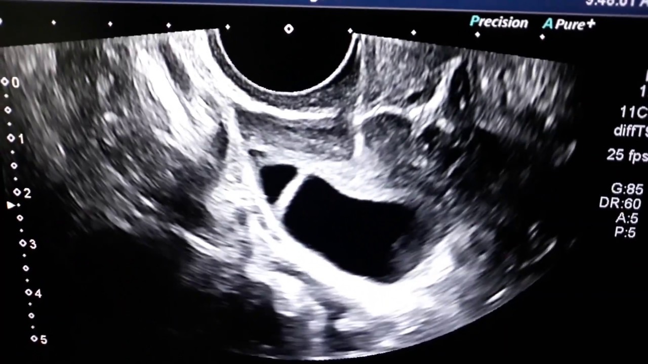 IVF Egg or Ovum Retrieval / Collection Procedure in IVF by Dr Arun