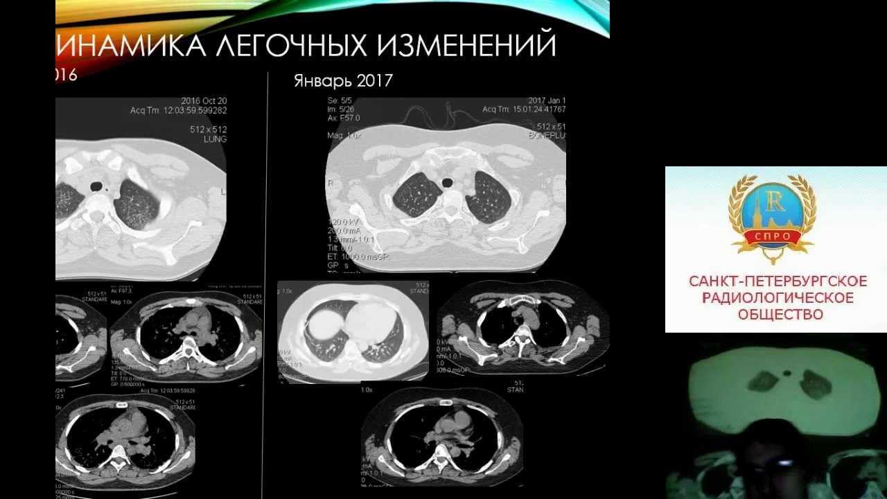 Войдак И.В. «Нейросаркоидоз, как проявление системного саркоидоза»